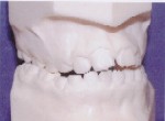 Crossbite - Occlusion - Pediatric Dentistry in Lakewood, WA