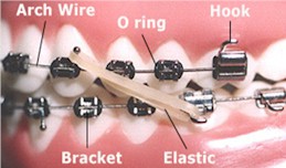 Orthodontic Terms - Pediatric Dentistry in Lakewood, WA