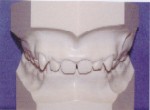 Overbite - Occlusion - Pediatric Dentistry in Lakewood, WA